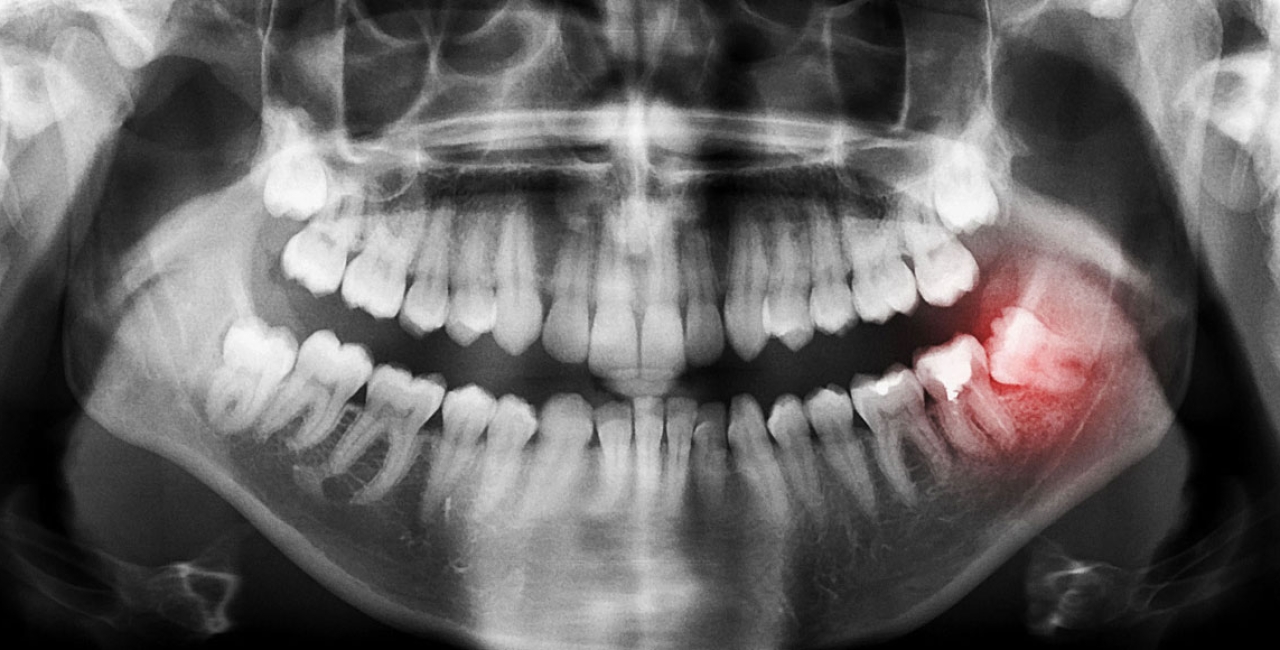 Živa iz dentalnog amalgama