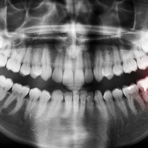 Živa iz dentalnog amalgama