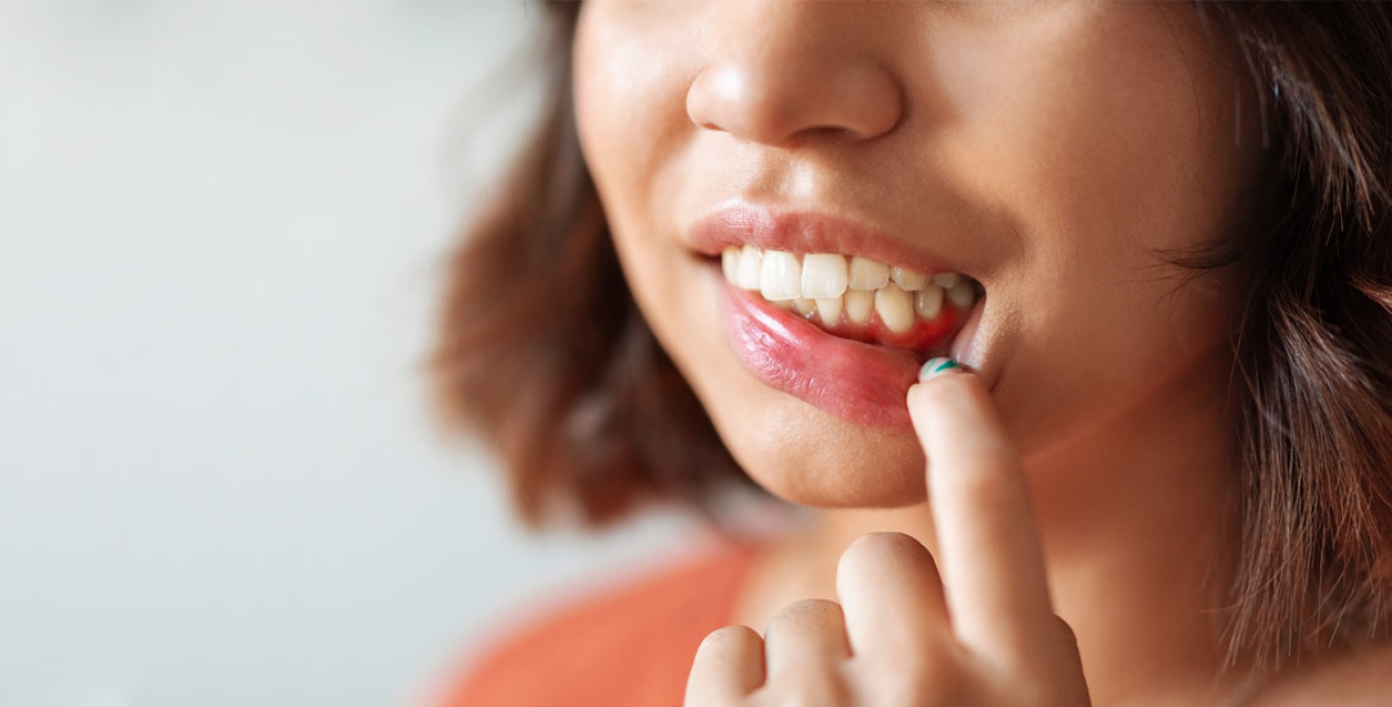 Gingivitis