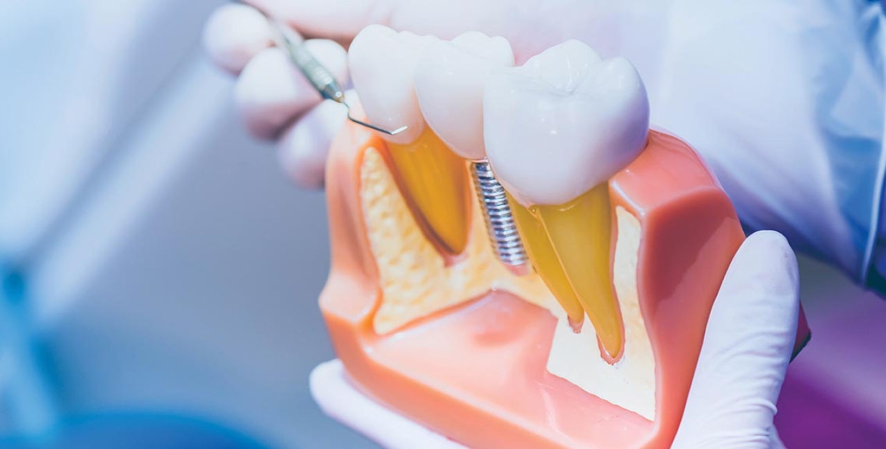 Što su zubni implantati i što morate znati o njima?