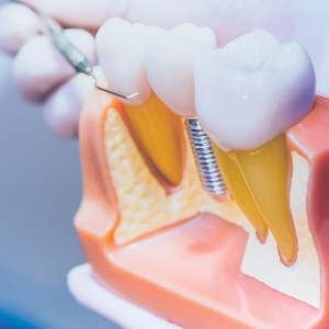 Što su zubni implantati i što morate znati o njima?